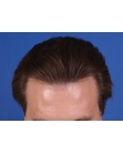 After Hair Transplant&nbsp;2 Sessions (Areas)